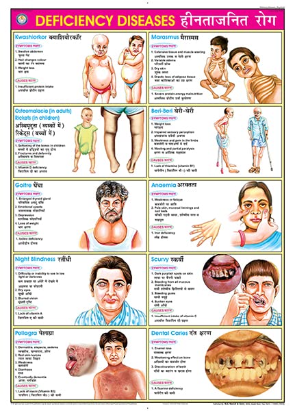 FN08 | TeachingNest | Deficiency Diseases Chart (70x100cm) | Food and Nutrition Chart | Wall Sticking | English - Hindi Combined [Wall Chart] teachingnest and Food and Nutrition Charts